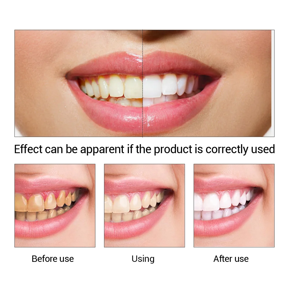FTEENPLY Teeth Whitening Essen - огляд і ціна Teeth Whitening At Home