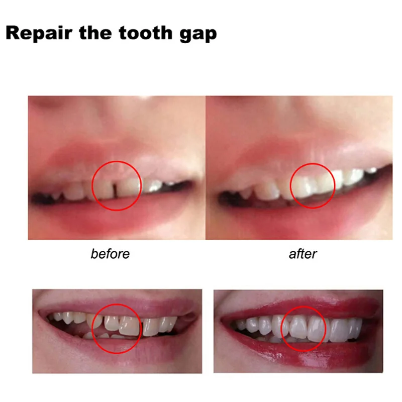 Tooth Repair Glue Shapeable Te - огляд і ціна Teeth Whitening At Home