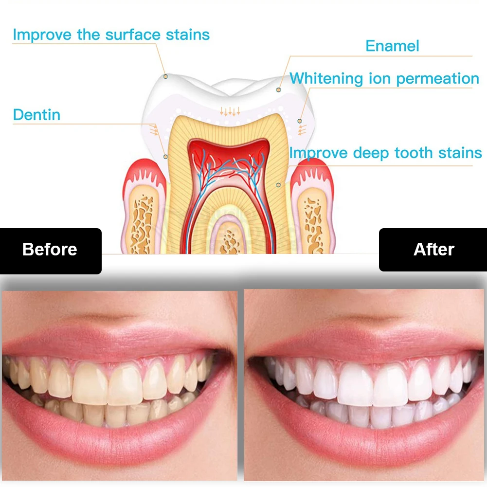 Dental Teeth Whitening Kit Min - огляд і ціна Teeth Whitening Zoom